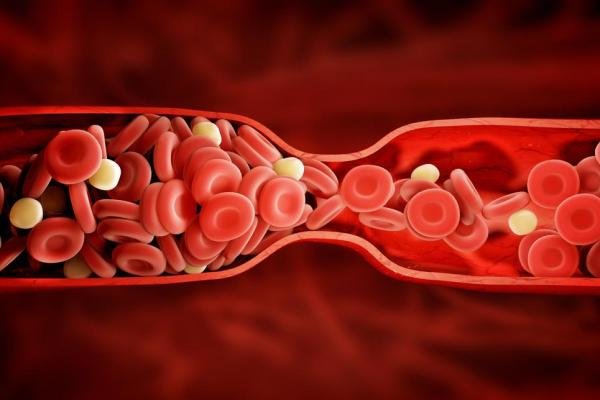 ارتباط رگ های واریسی با افزایش احتمال لختگی خون
