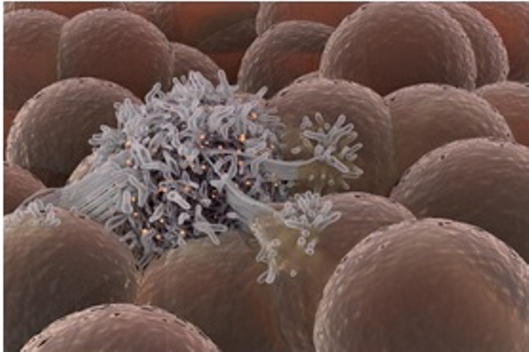کشف پروتئینی که در ابتلا به سرطان سینه نقش دارد