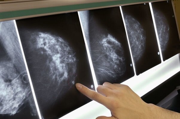 پیش بینی دقیق سرطان سینه با هوش مصنوعی