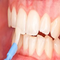فلوراید بیش از حد موجب پوسیدگی مینای دندان می‌شود