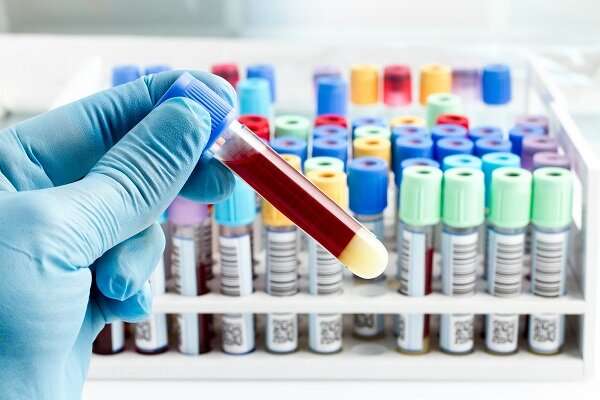تشخیص سرطان پروستات با آزمایش جدید خون و ادرار