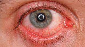 ویروس کرونا سلول‌های چشم را آلوده می‌کند