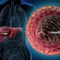 هپاتیت A، بیماری که با سرماخوردگی اشتباه گرفته می‌شود