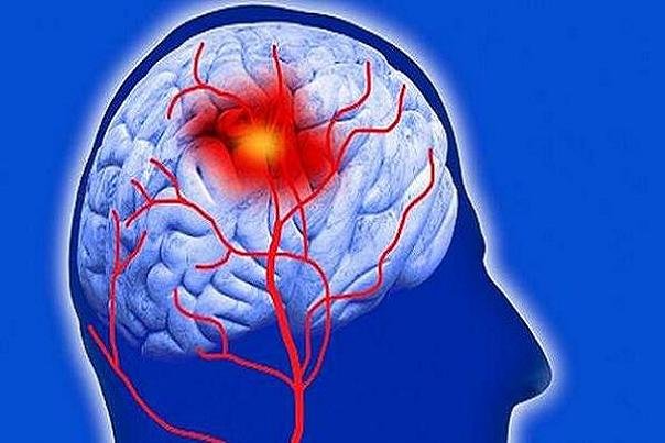 آشنایی با فاکتورهای پرخطر احتمال خونریزی در بازماندگان سکته مغزی